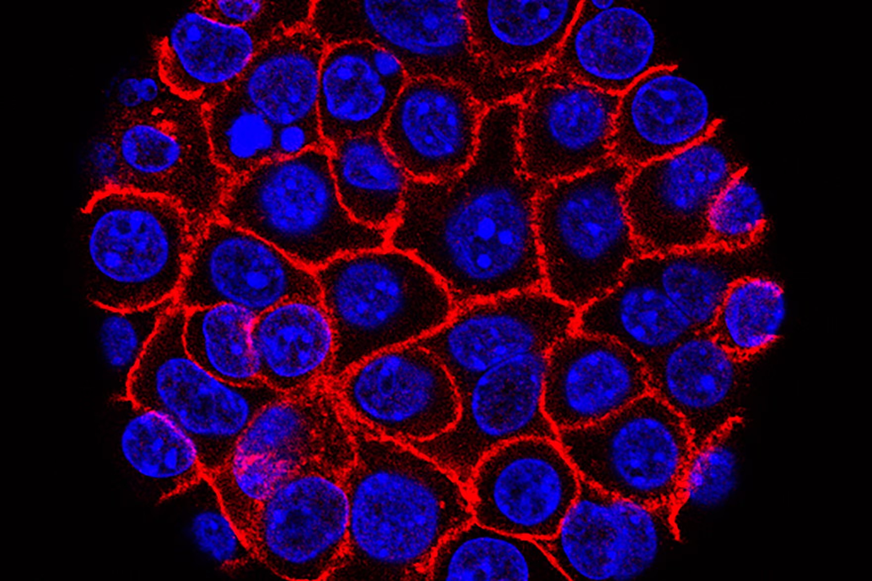 Pancreatic cancer cells under a microscope. Photograph: Min Yu/USC/NIH/AP